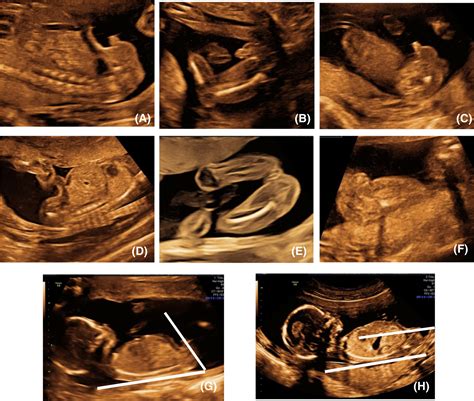 New Advances in Prenatal Techniques for Determining Fetal Gender