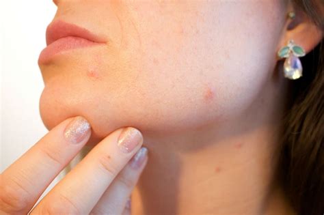 Pimples as a Manifestation of Insecurity and Self-Doubt