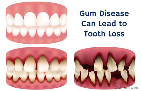 Possible Dental Conditions Associated with Tooth Loss