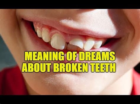 Possible Meanings of Dreaming About Crumbling Teeth