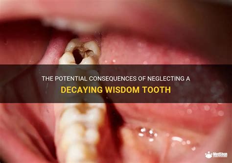 Potential Consequences of Neglecting Tooth Loss