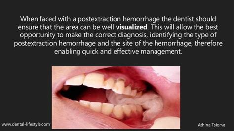 Psychological Insights into Dreams of Hemorrhage from a Dental Element