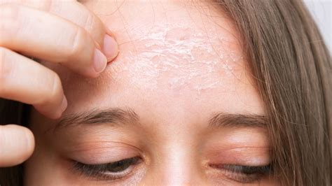 Psychological Significance of Flaking Facial Epidermis in a Dream