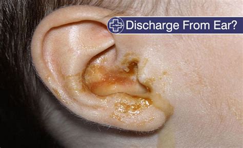 Recognizing the Symptoms of Ear Discharge