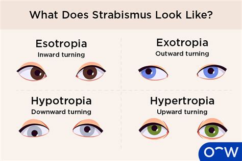 Reflections and Action: What to Do with Strabismus Dreams?