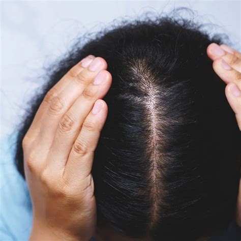 The Curious Case of Hair Loss: Unraveling the Enigmas