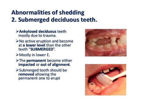 The Enigma of Pain-free Tooth Shedding