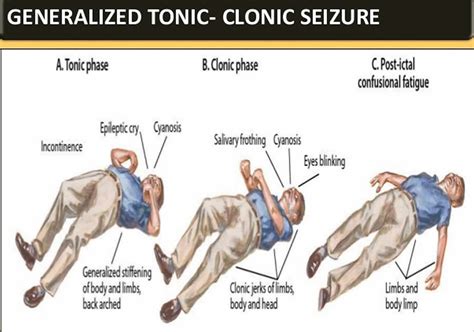 The Frog's Precision Tongue: A Flawless Seizure