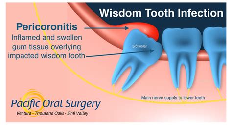 The Health Risks Associated with an Infected Wisdom Tooth and Its Extraction