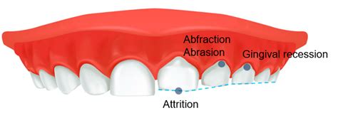 The Impact of Inadequate Sleep Patterns on Bruxism in Children