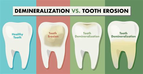 The Relationship Between Eroding Teeth and Anxiety in Dreamscapes