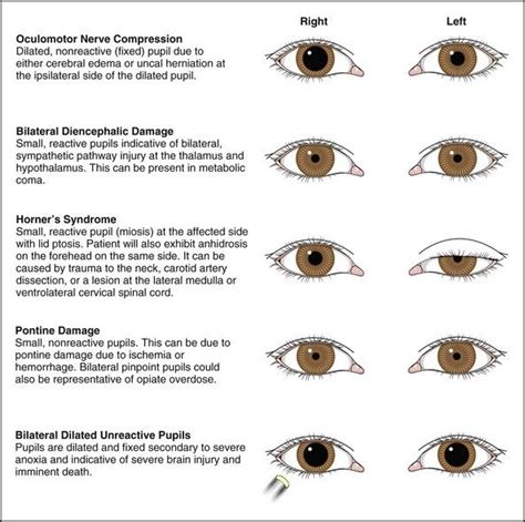 The Secret Interpretations of Pupils' Varying Sizes in Dreams