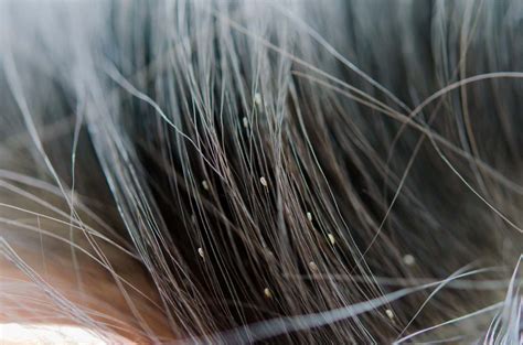 The Significance Behind Dreaming of Lice on Your Scalp