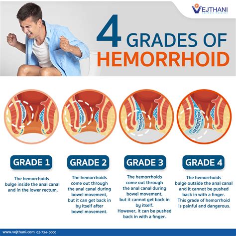 The Significance of Home Hemorrhoids in Interpretation of Dreams