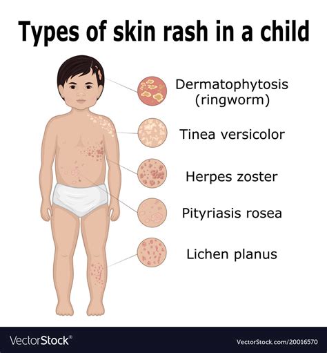 The Significance of Recognizing Typical Childhood Skin Irritations