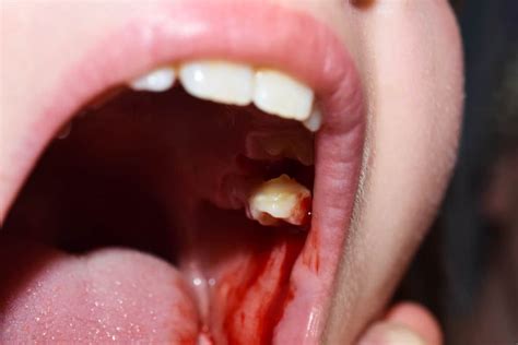 The Symbolic Meaning of a Bloody Tooth Falling Out