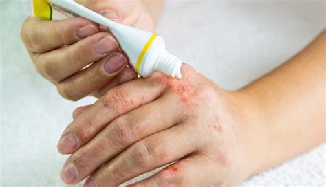 Tips for Alleviating and Treating Rashes at Home