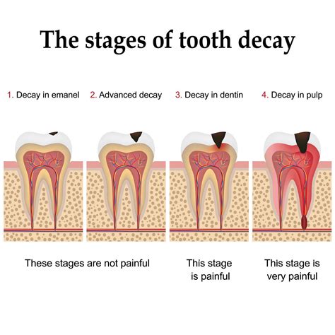 Tips for Decoding and Taking Action on Your Vision of Decayed Teeth