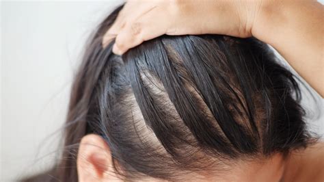 Tips for Managing and Preventing Hair Thinness and Balding in Children