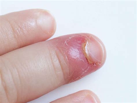 Treatment Options for an Infected and Pus-filled Injury on the Palm