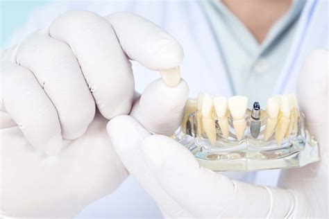 Uncover the Significance of Your Dream About Dental Prosthesis