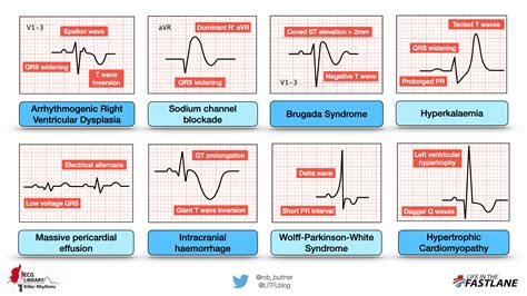 Understanding ECG Readings on Your Apple Device