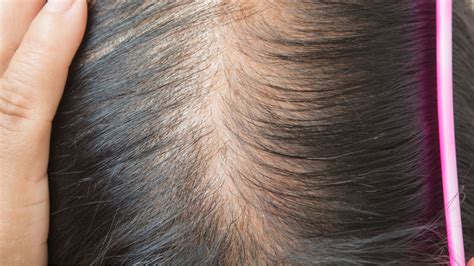 Understanding Female Hair Loss: Decoding the Mysterious Bald Patch