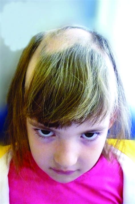 Understanding Hair Loss in Children