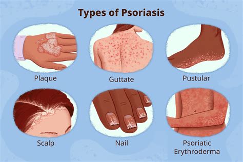 Understanding Psoriasis: Causes, Symptoms, and Treatment