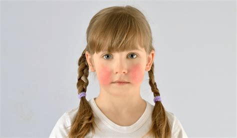 Understanding Red Cheeks in 8-Year-Olds: Causes and Solutions