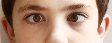 Understanding Strabismus: The Impact on Vision