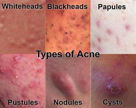 Understanding the Causes of Large Acne Lesions