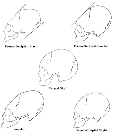 Understanding the Link between Utilizing Headphones and Modifications in Cranial Form