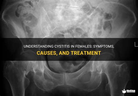 Understanding the Manifestations of Cystitis in Young Females