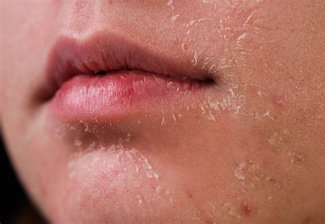 Understanding the Message of Skin Peeling or Shedding in Your Dreams