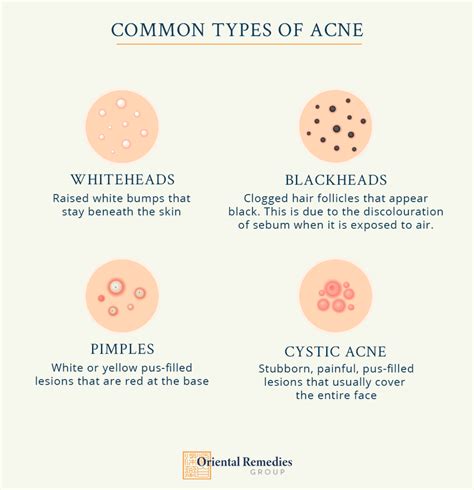 Understanding the Origins of Acne