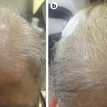 Understanding the Origins of Indentations on the Scalp Resulting from Overusing Headsets