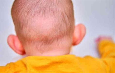 Understanding the Reasons for Hair Loss in Children