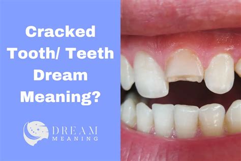 Understanding the Symbolism of Tooth Loss in Children's Dreams