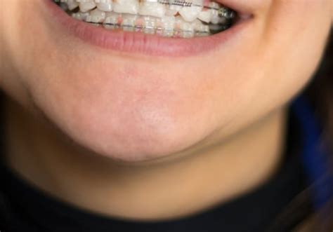 Unraveling the Hidden Significance: Interpreting the Symbolism of Orthodontic Appliances on Others