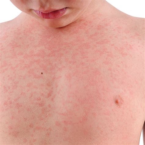 Unraveling the Origins of Childhood Rashes