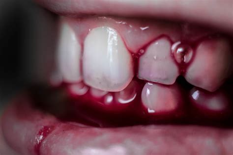 Unsettling Images and Emotions: My Blood-Stained Escapade of a Wobbly Incisor