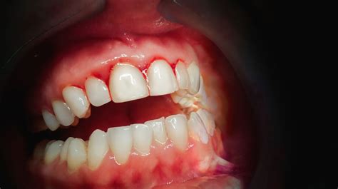 When to Seek Dental Help: Identifying Serious Issues Behind a Bleeding Tooth